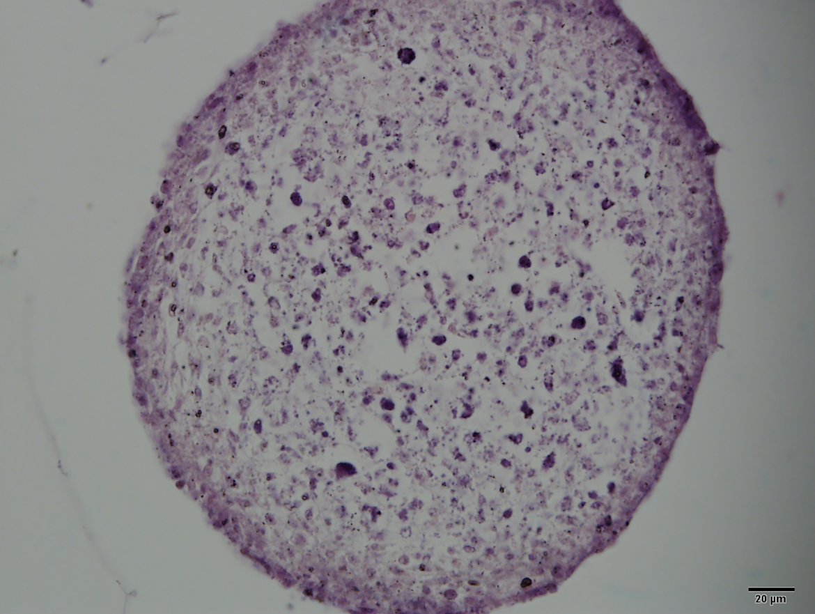 Histologia com coloração Hematoxilina-Eosina (Sigma) do esferóide da cultura 3D da célula tumoral óssea (osteosarcoma) de humano (linhagem MG63). Os esferoides foram cultivados em meio para cultura 3D: 50 μg/mL Ácido L Ascórbico, 1,25 μg/mL Album ina Humana, 1 X ITS (Insulina, transferrina e selênio) em DMEM suplementado com 10% SFB. A imagem foi adquirida no microscópio de luz Olympus BX51 (Olympus, Dinamarca) acoplado a câmera de vídeo digital e com software Olympus DP2-BSW do Laboratório de Zoofisiologia e Bioquímica Comparativa (LZBC). Aumento: 40 x, barra de escala 20 μm. Autoria: Bruna Carla Casali